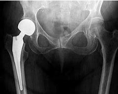 Hip Replacement Surgeons Company in Adelaide